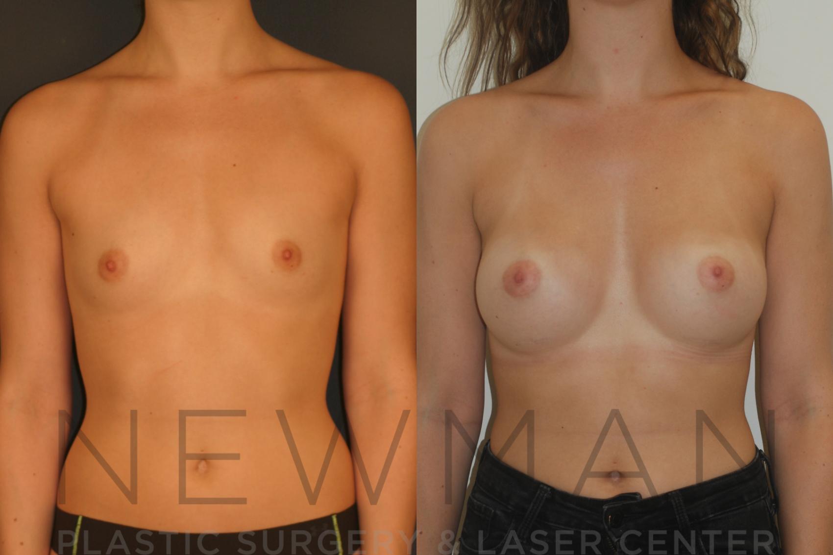 Breast Augmentation before and after case 7