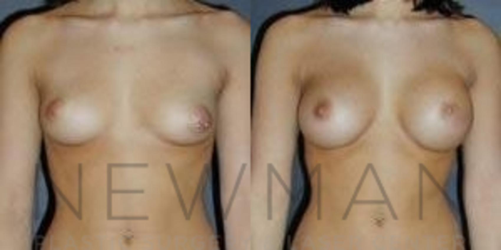 Breast Augmentation before and after case 79