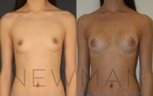 Breast Augmentation before and after, case 8, Front view