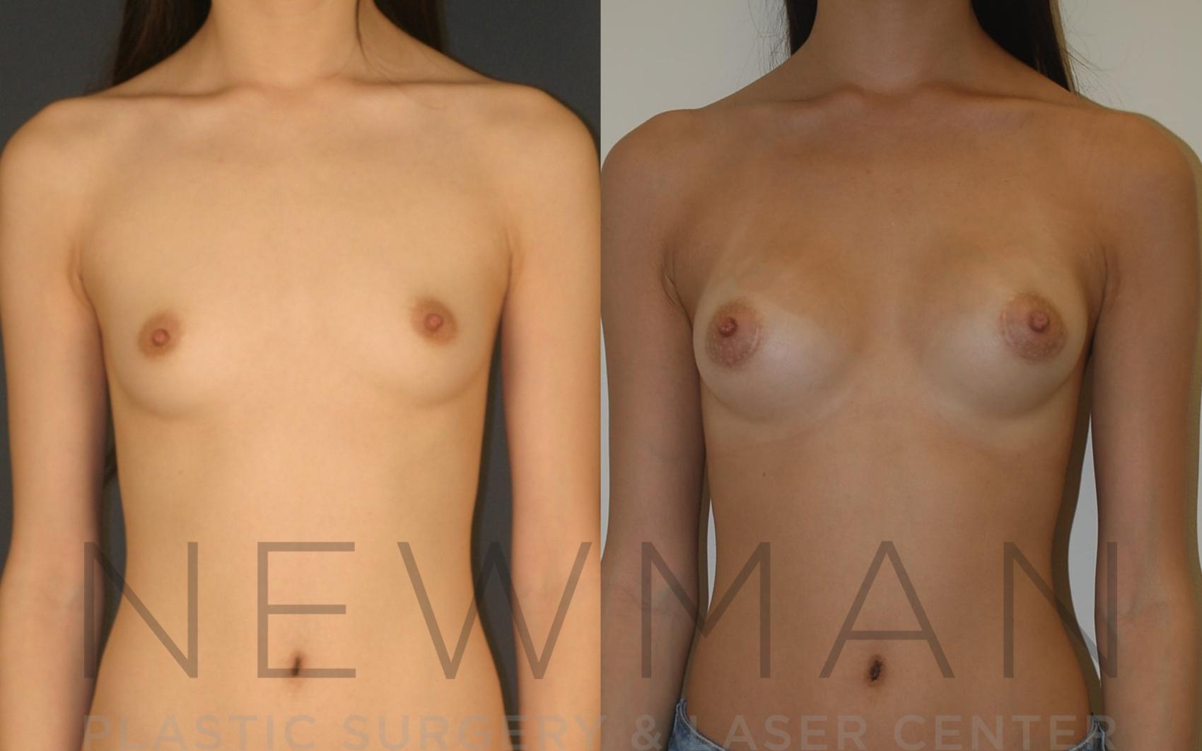 Breast Augmentation before and after case 8