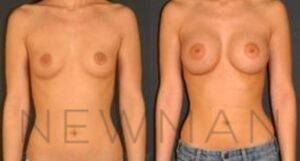 Breast Augmentation before and after, case 81, Front view