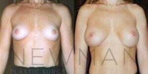 Before & after case 82
