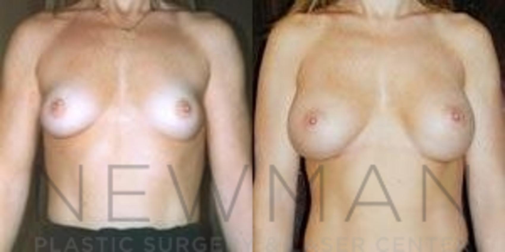 Breast Augmentation before and after case 82