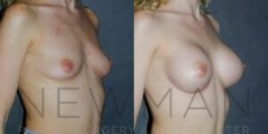 Breast Augmentation before and after, case 83, Right Oblique view