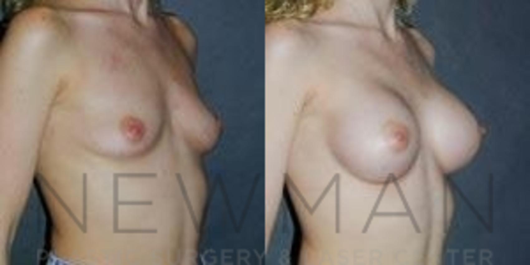 Breast Augmentation before and after case 83