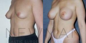 Before & after case 84