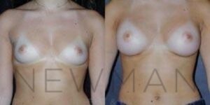 Breast Augmentation before and after, case 85, Front view