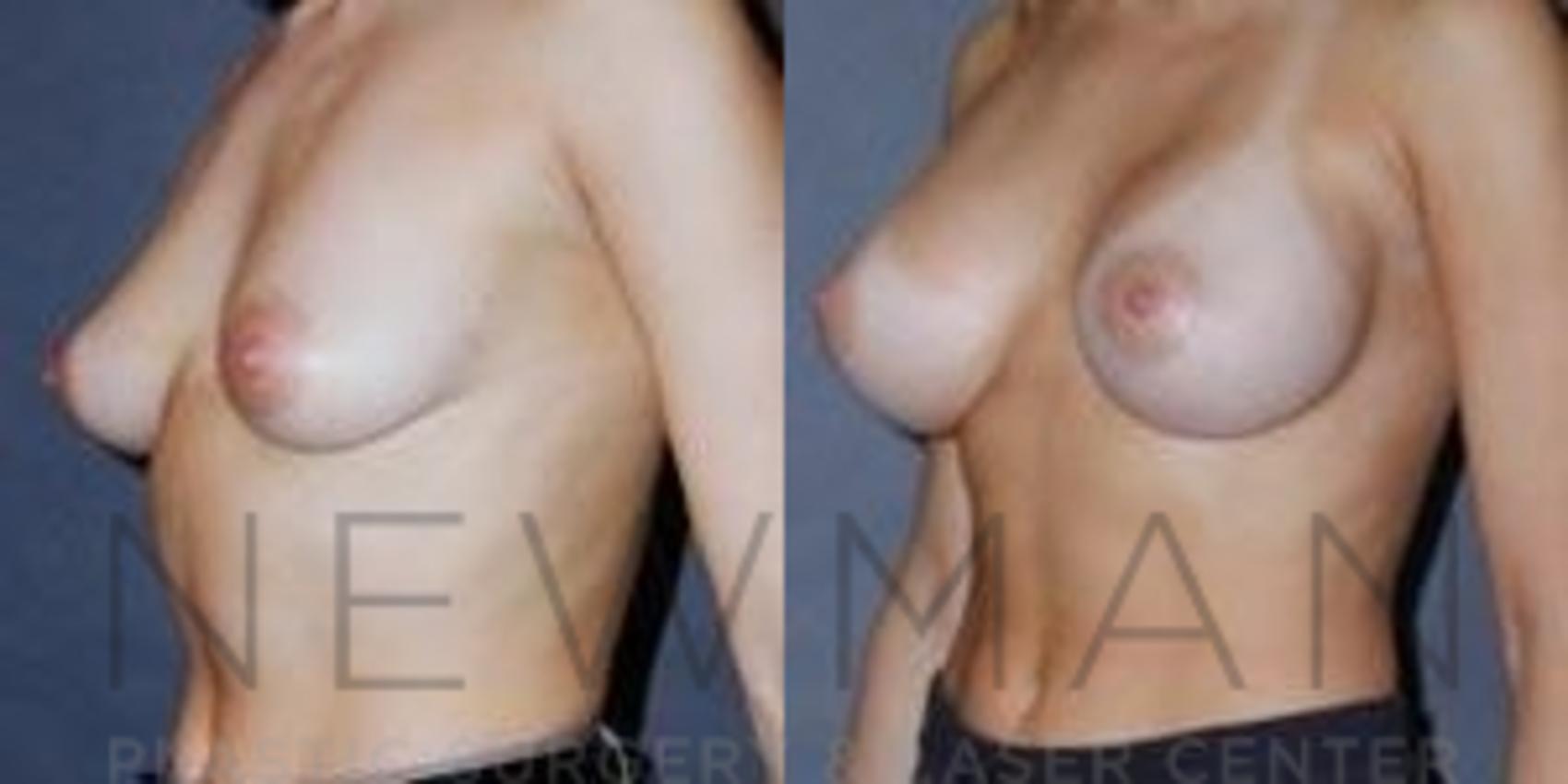 Breast Augmentation before and after case 86