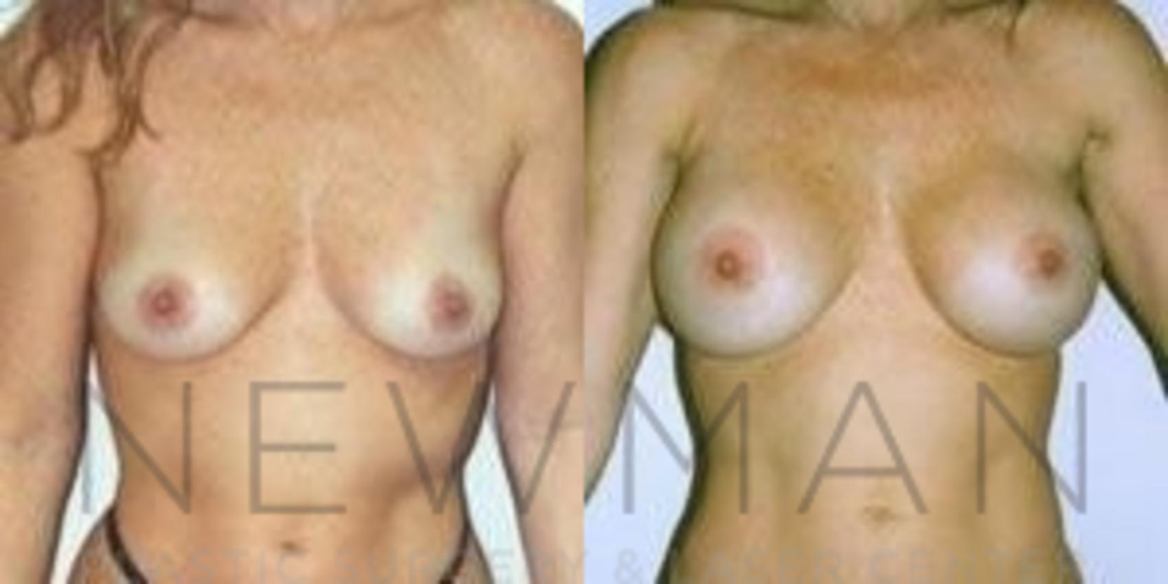 Breast Augmentation before and after case 88