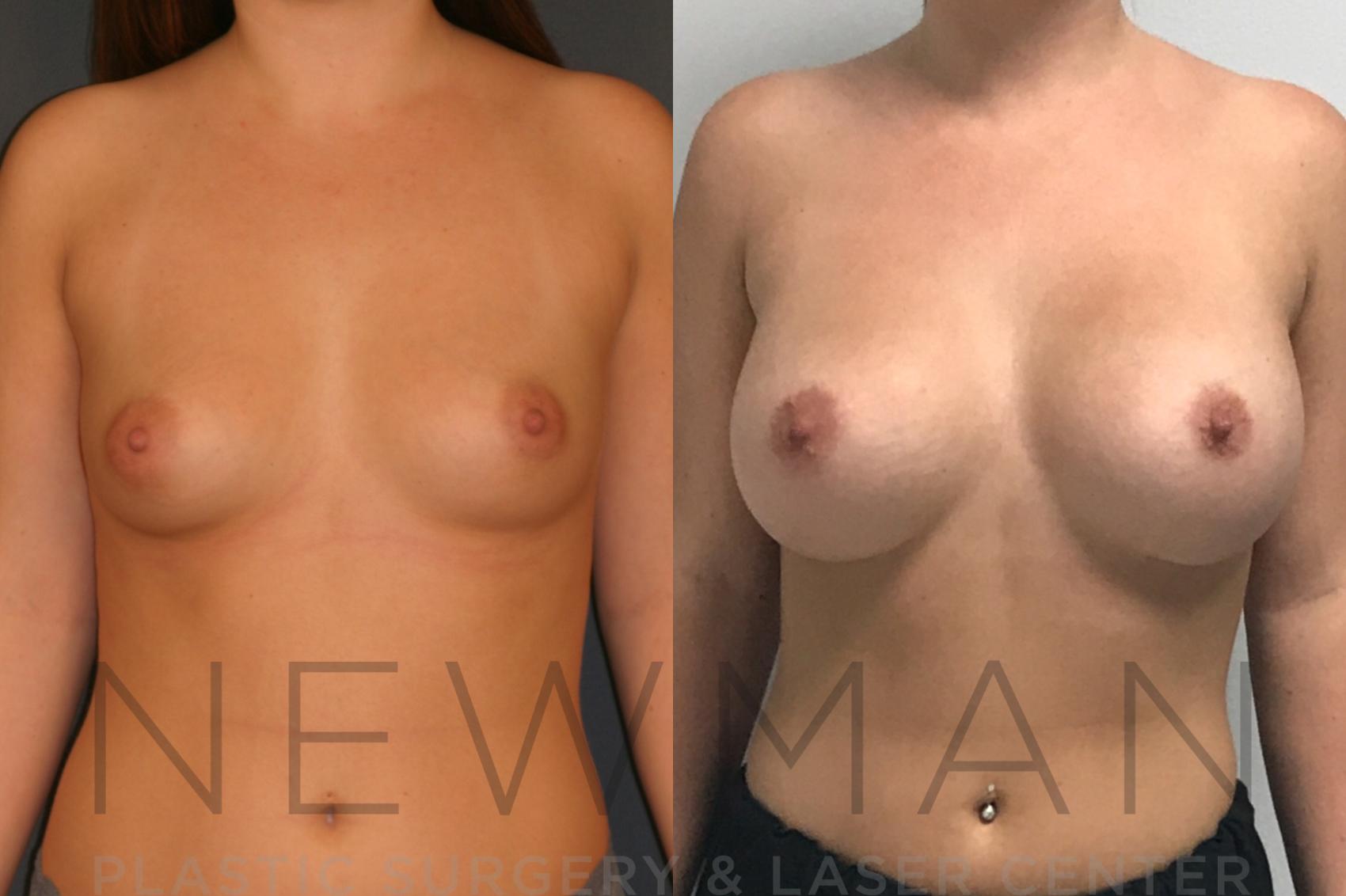 Breast Augmentation before and after case 9