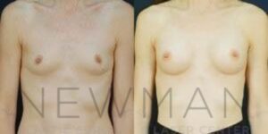 Breast Augmentation before and after, case 90, Front view