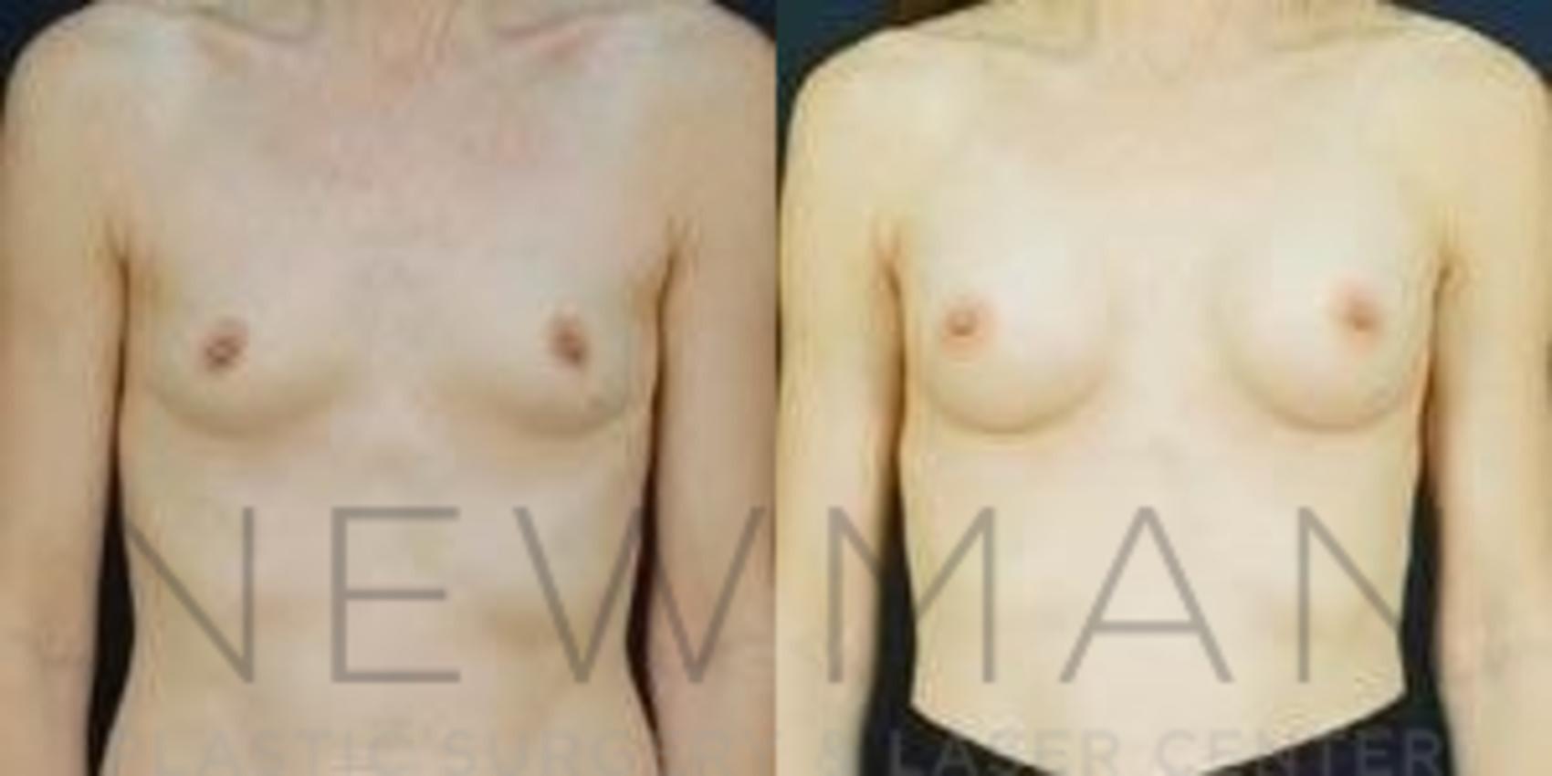 Breast Augmentation before and after case 90