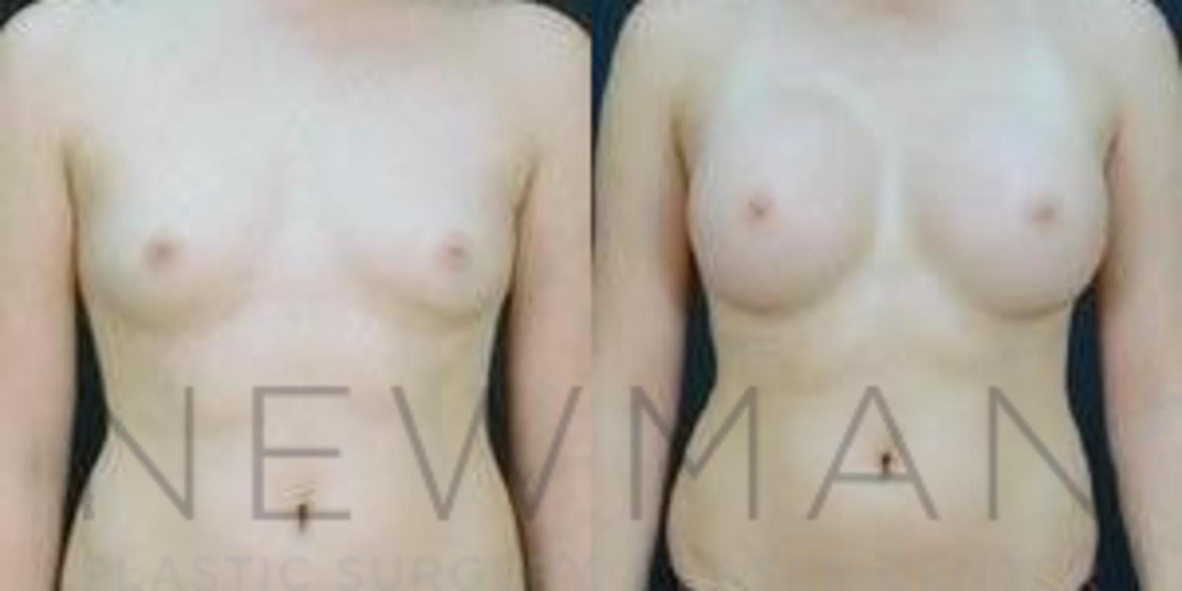 Breast Augmentation before and after case 92
