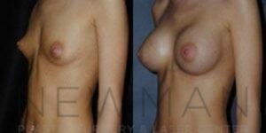 Before & after case 93