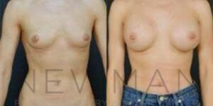 Before & after case 94