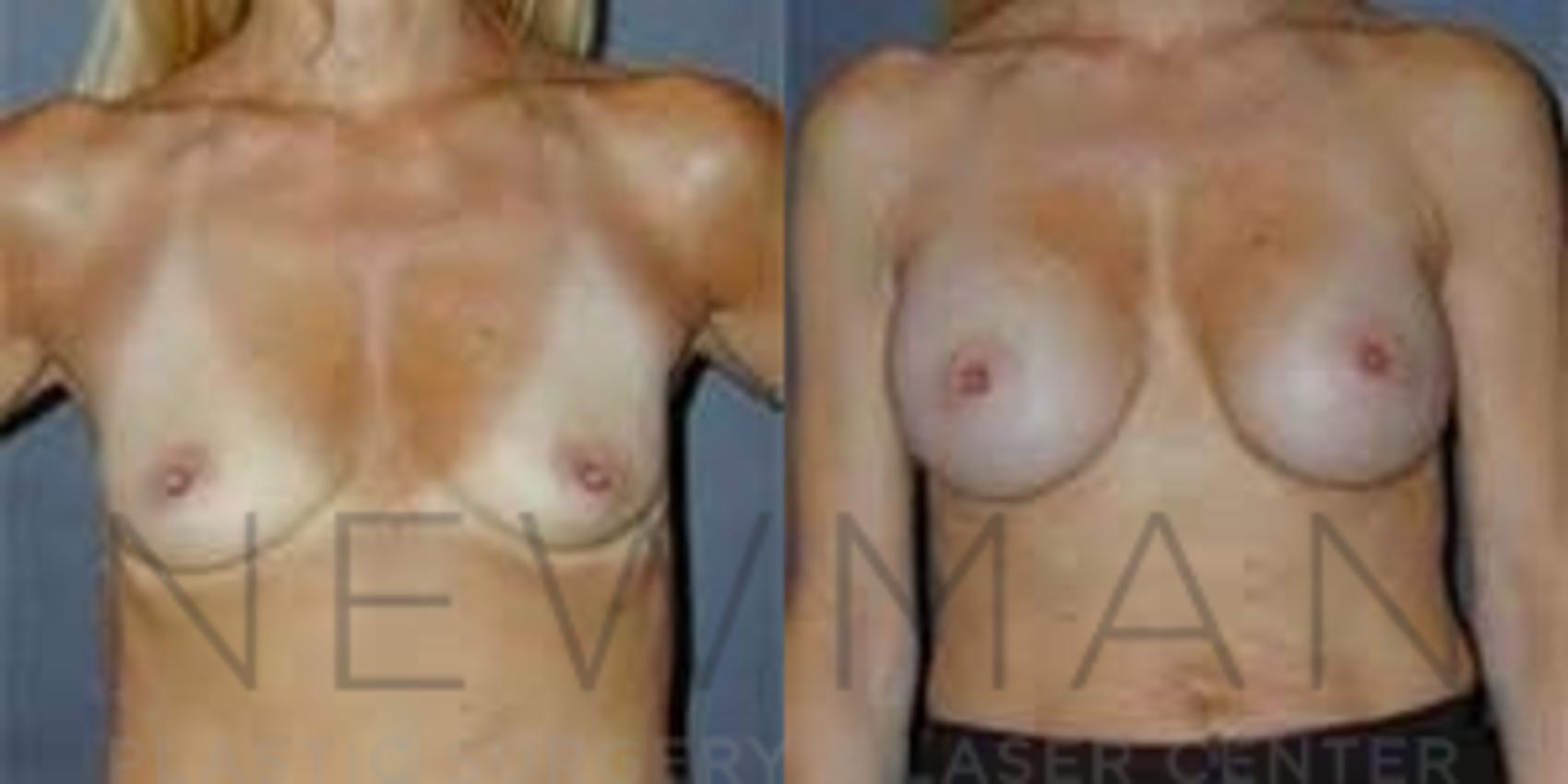Breast Augmentation before and after case 96