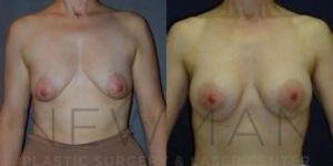 Breast Augmentation before and after, case 97, Front view