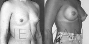 Before & after case 99