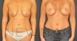 Breast Lift before and after, case 60, Front view