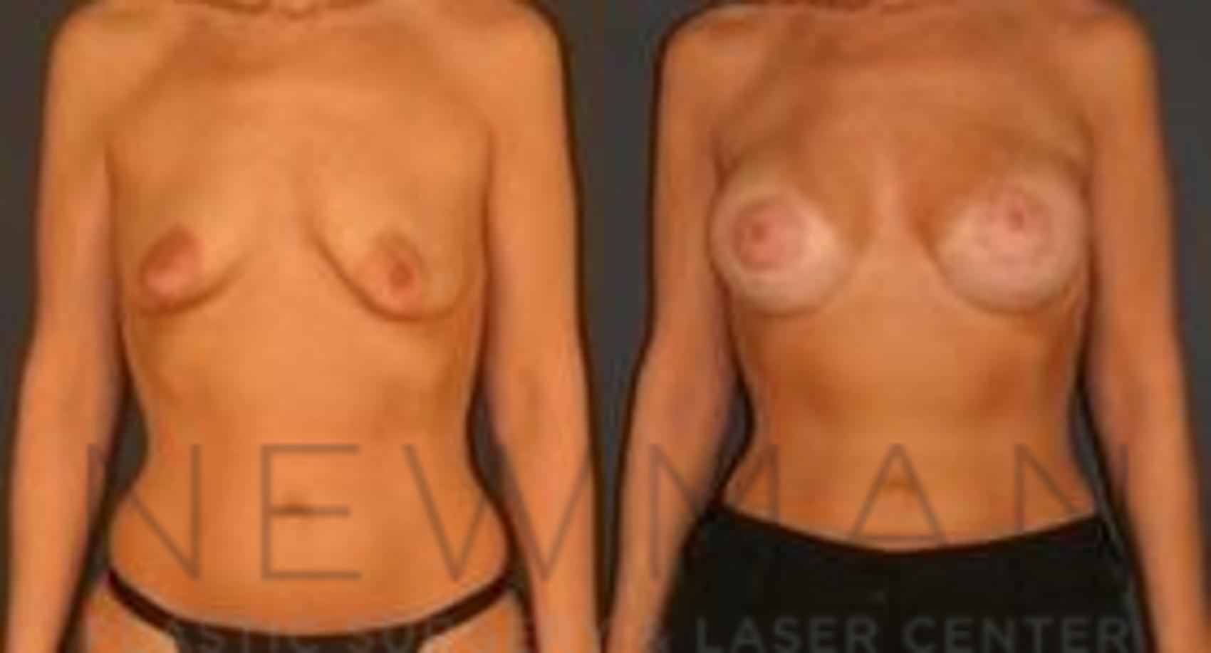 Breast Lift before and after case 61