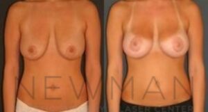 Breast Lift before and after, case 62, Front view