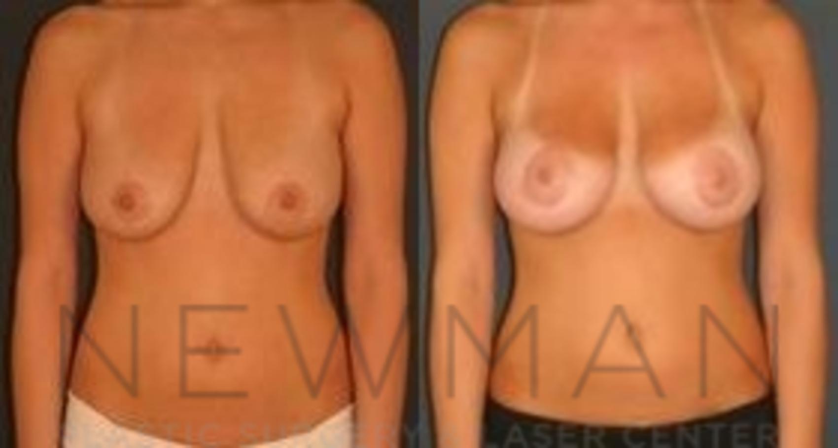 Breast Lift before and after case 62