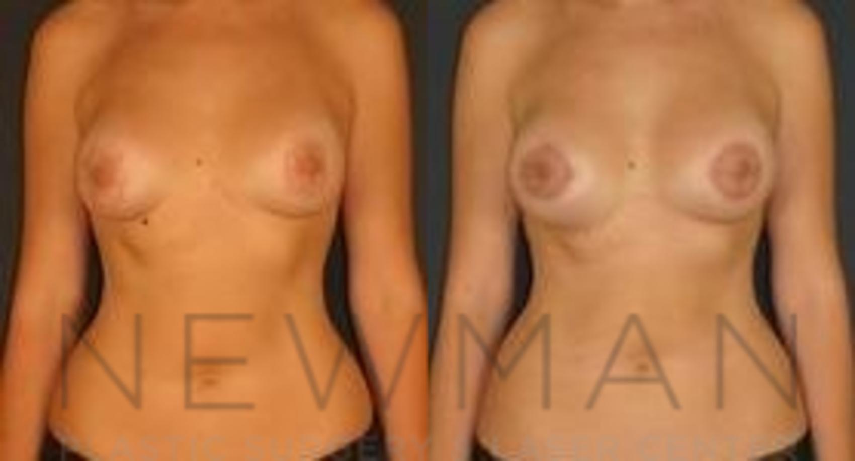 Breast Lift before and after case 63