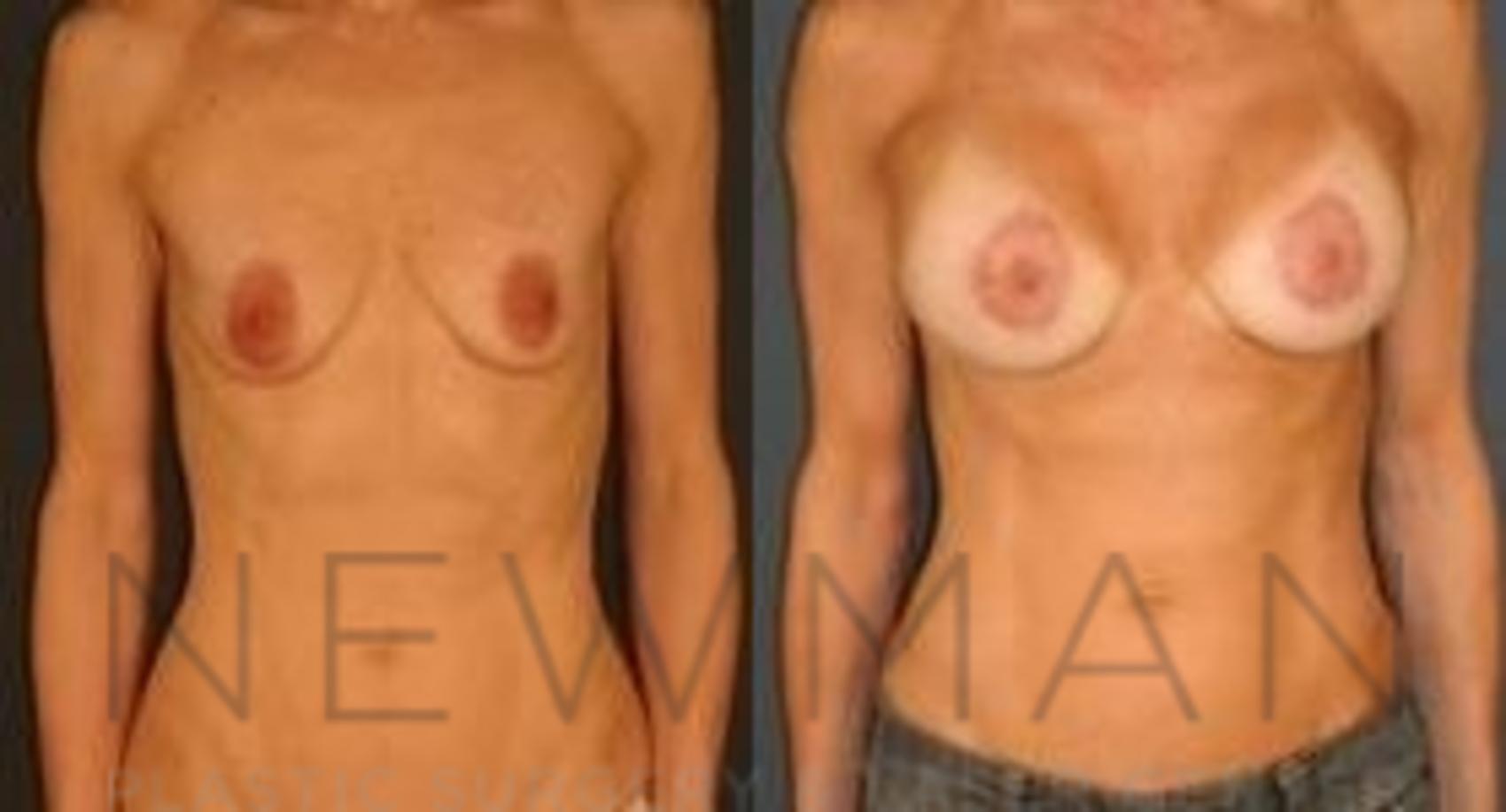 Breast Lift before and after case 64