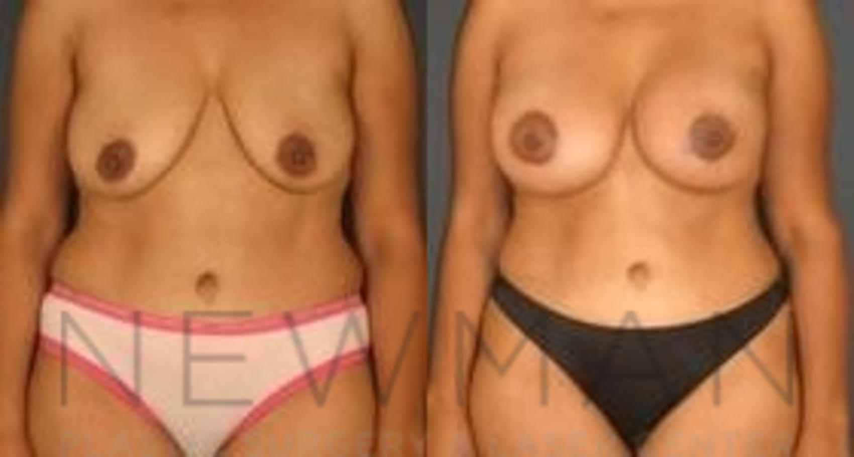 Breast Lift before and after case 65