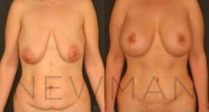 Case 67 before and after