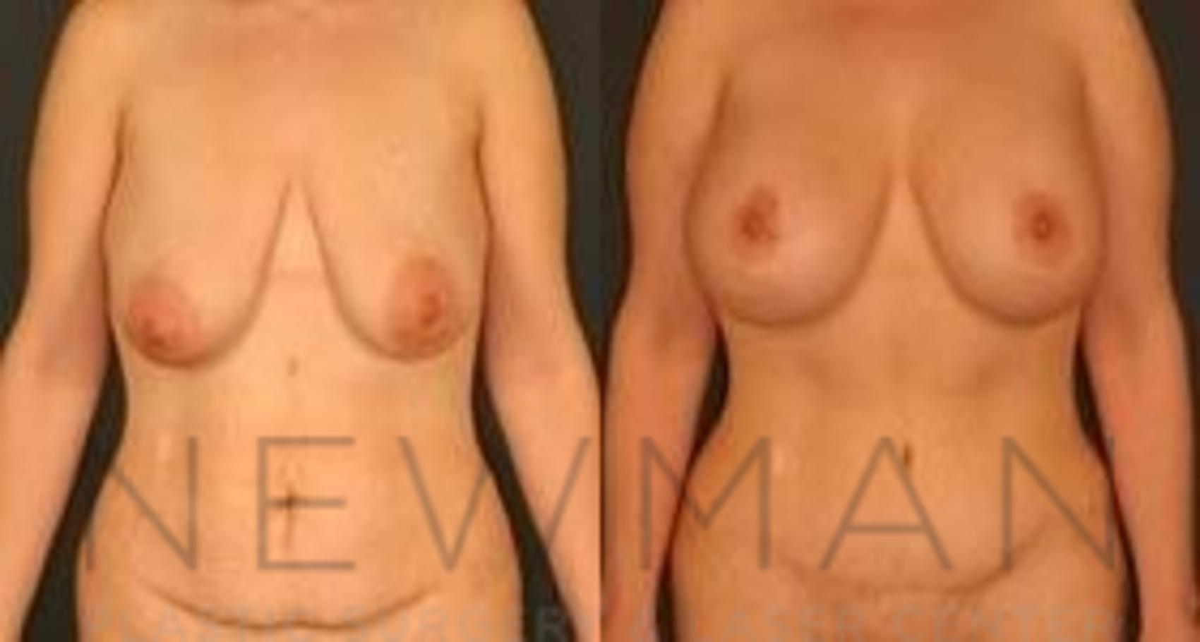 Breast Lift before and after case 67