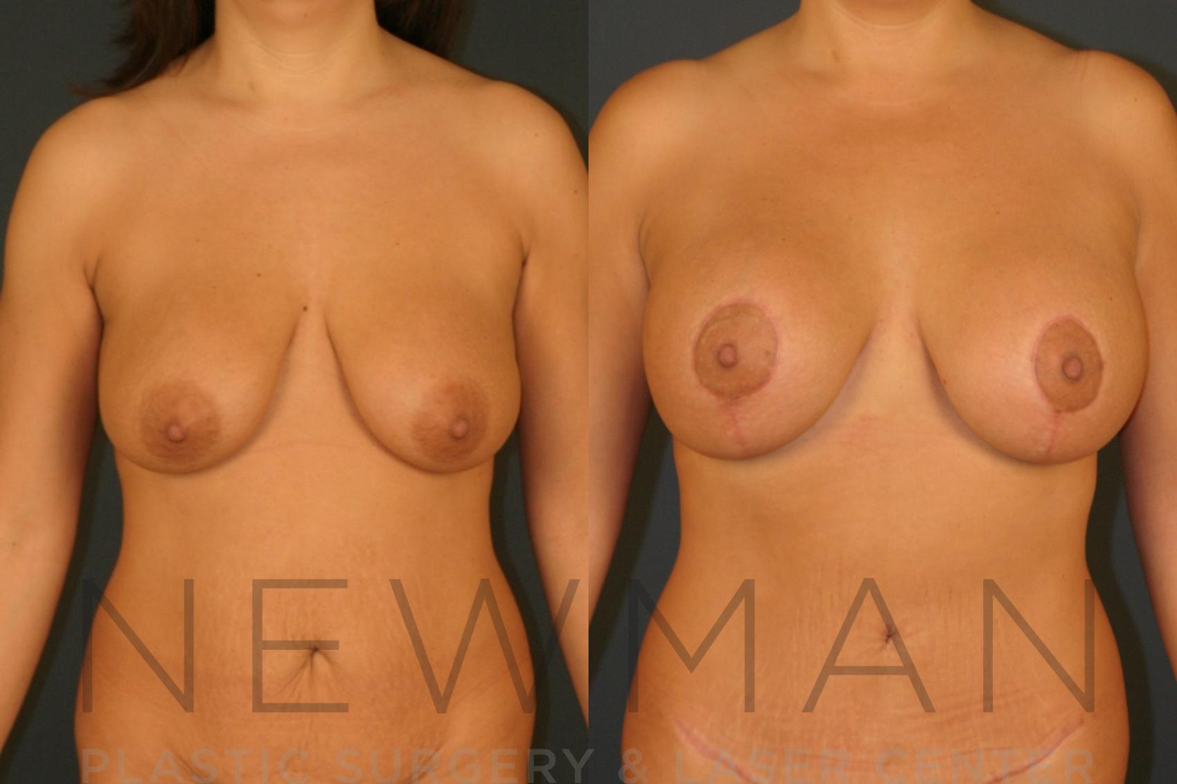 Breast Lift with Augmentation before and after case 125