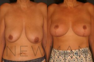 Case 126 before and after
