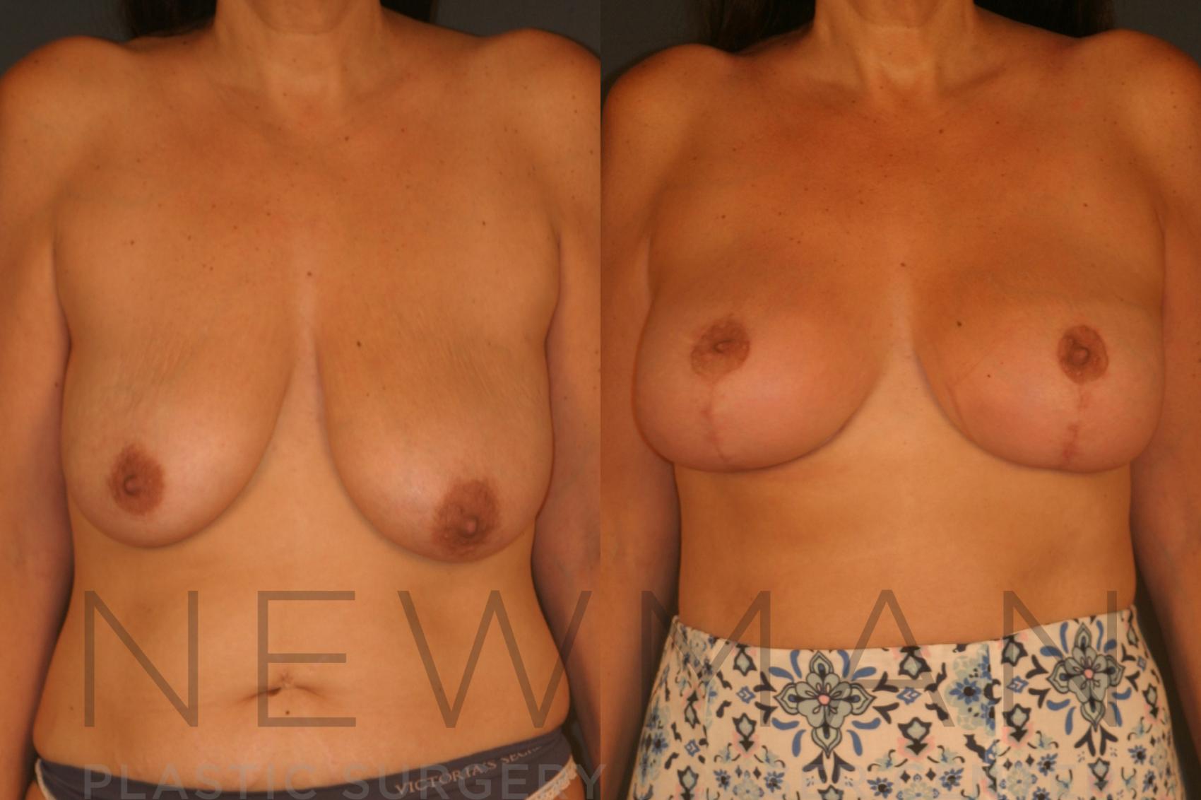Breast Asymmetry before and after case 126