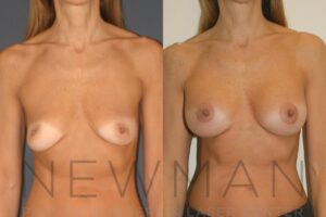 Case 129 before and after
