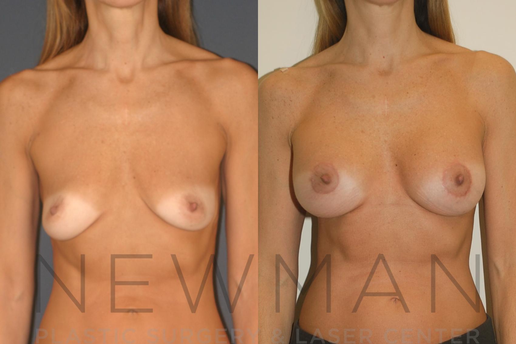 Breast Asymmetry before and after case 129