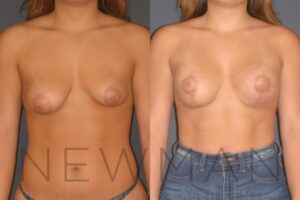 Case 130 before and after