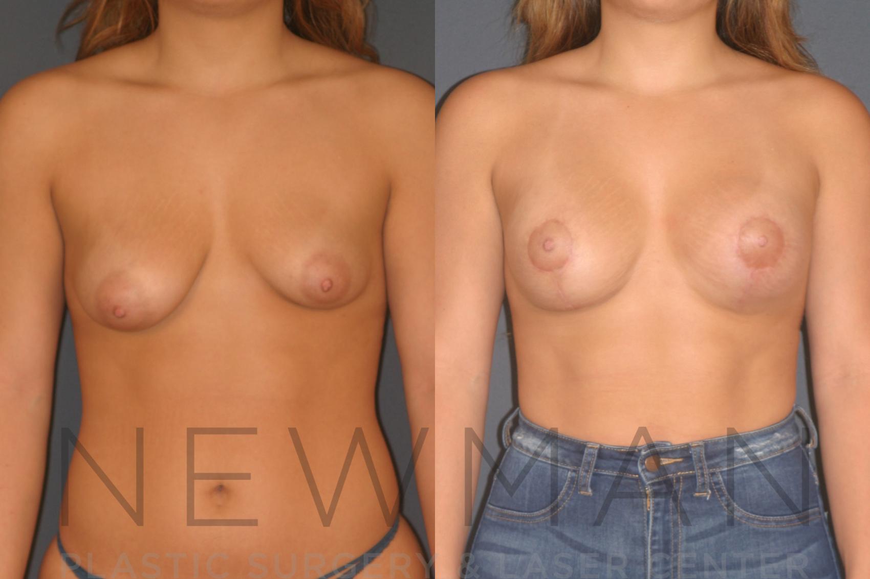 Breast Lift before and after case 130