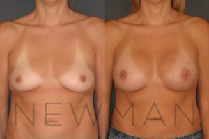 Case 131 before and after
