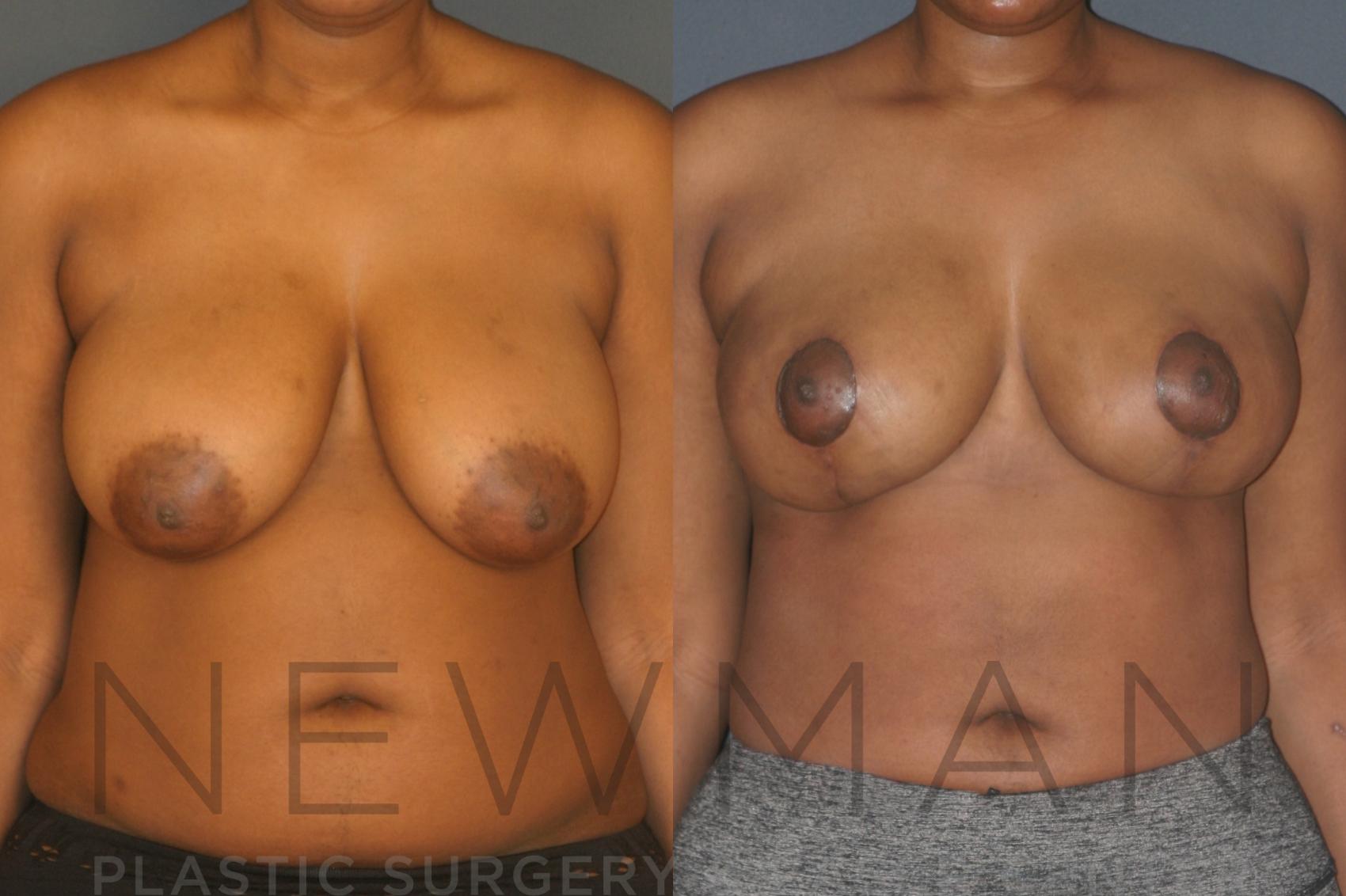 Breast Augmentation before and after case 132