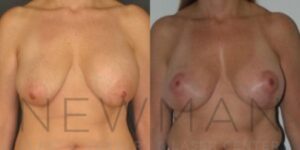 Before & after case 52