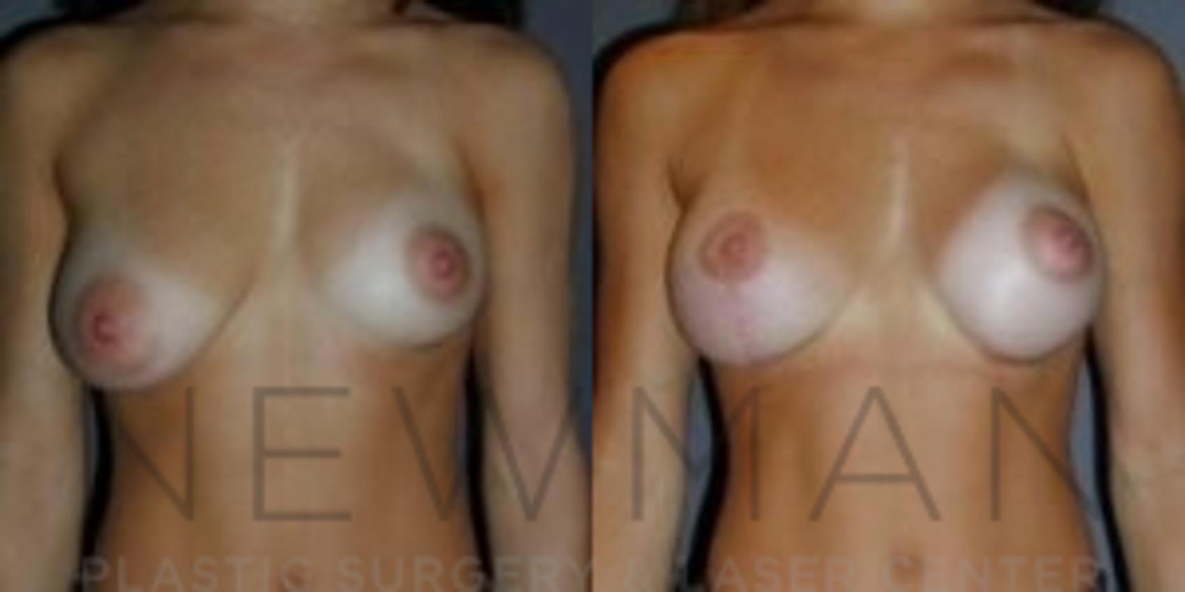 Breast Lift with Augmentation before and after case 53