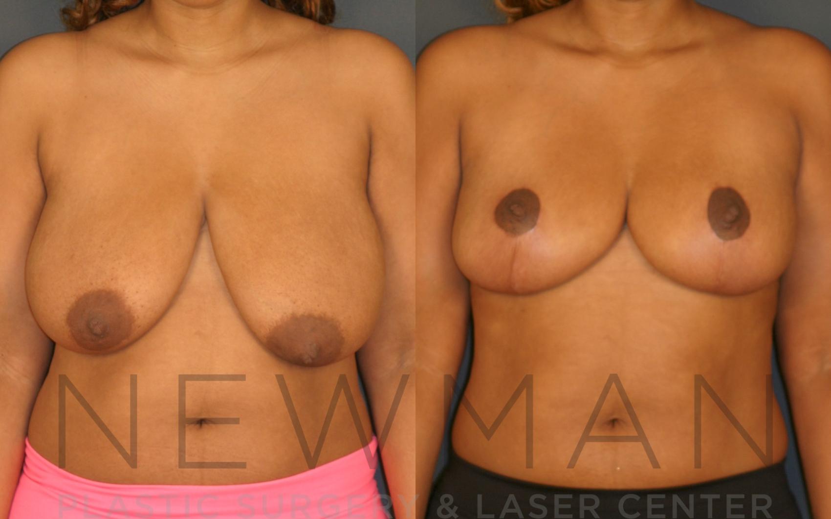 Breast Reduction before and after case 28