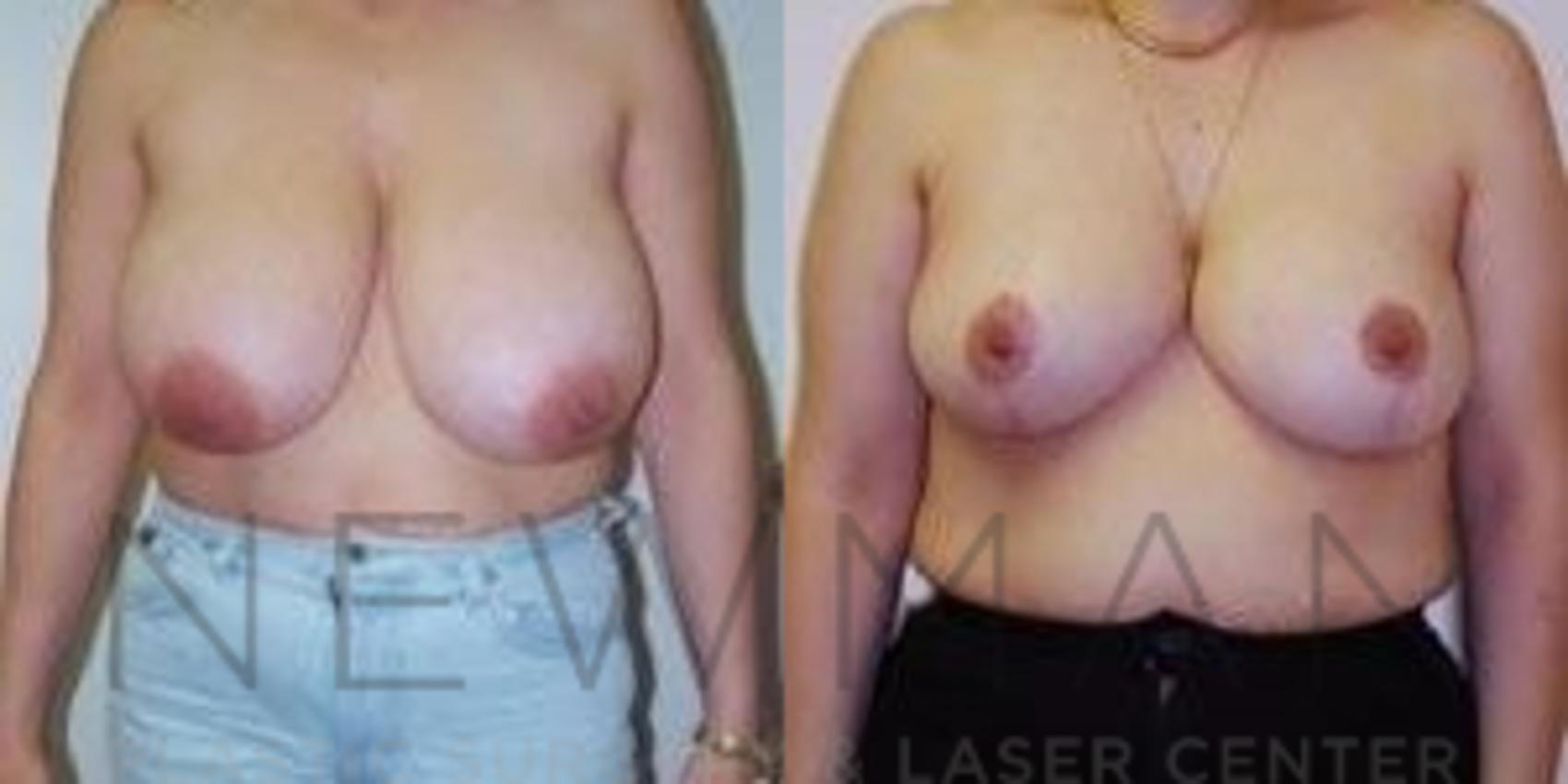 Breast Reduction before and after case 40