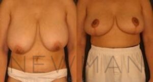 Case 42 before and after