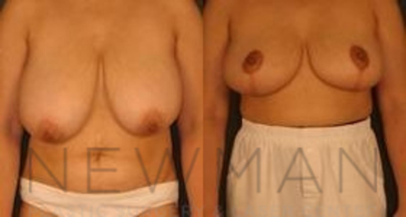Breast Reduction before and after case 42