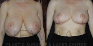 Case 43 before and after