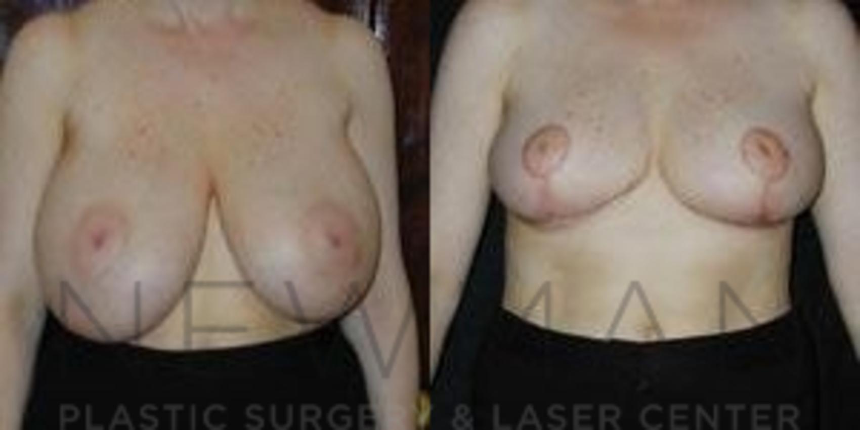Breast Reduction before and after case 43