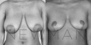 Case 44 before and after