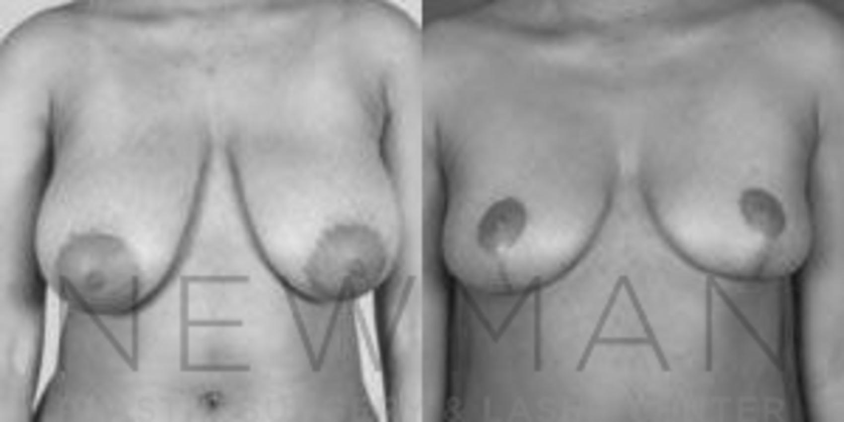 Breast Reduction before and after case 44